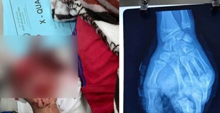 Đốt pháo tự chế ngày Tết, bé trai 14 tuổi ở Tiền Giang bị giập nát bàn tay