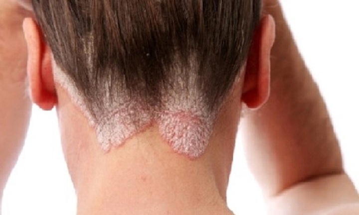 Điều trị sớm bệnh vẩy nến tránh  nguy cơ biến chứng  