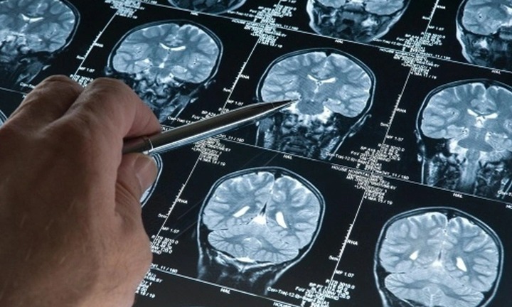  Giun ký sinh làm tổ trong não cô gái trẻ, thủ phạm là món ăn khoái khẩu 