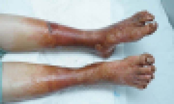 Nghe lời quảng cáo trên mạng, người phụ nữ hoại tử hai bàn chân nghiêm trọng