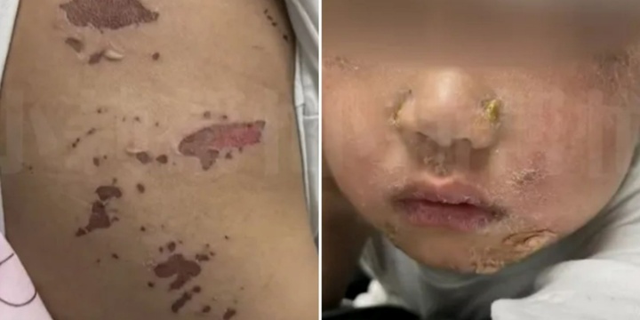 Bé trai bỏng nhẹ ở miệng, 3 ngày sau lở loét toàn thân, nguyên nhân ít ai ngờ