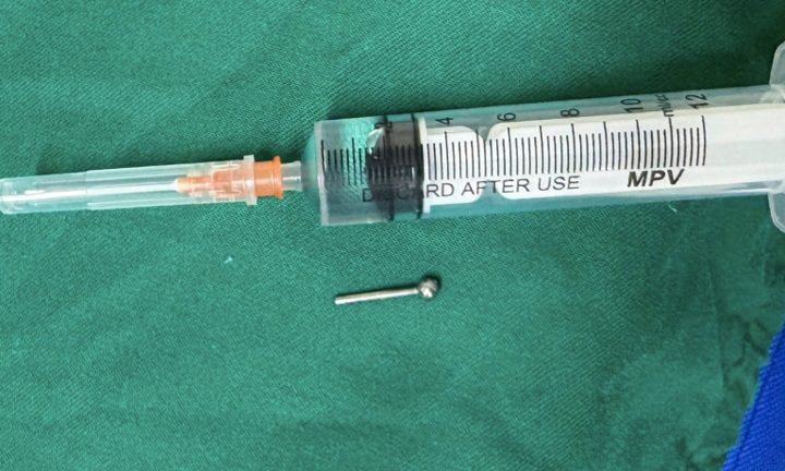 Cô gái 19 tuổi phải nhập viện cấp cứu vì vô tình nuốt phải chiếc khuyên lưỡi