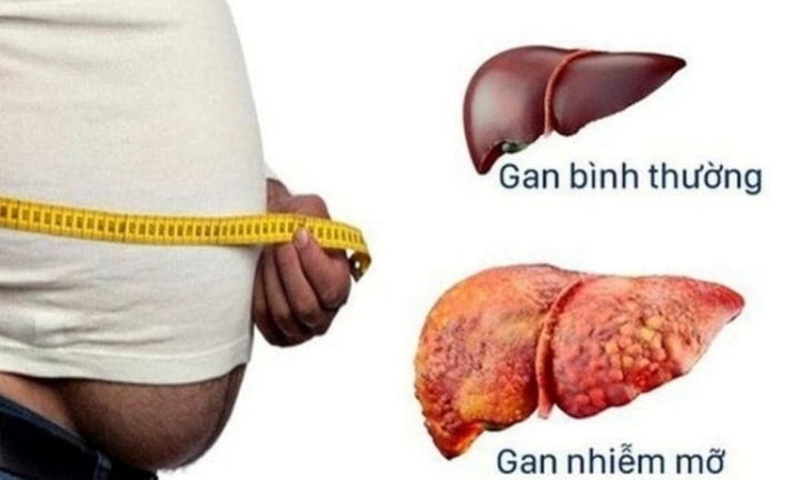 Đẩy lùi gan nhiễm mỡ với 5 thức uống đơn giản từ nhà bếp