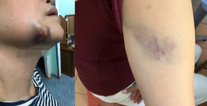 Vụ nhóm thanh niên đánh dã man nữ nhân viên y tế: Tình tiết mới nhất