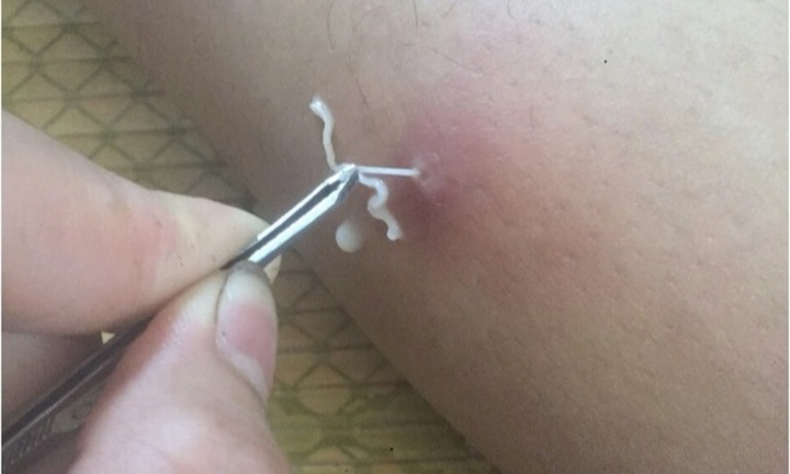 Rùng mình: Giun rồng dài hơn 10cm 