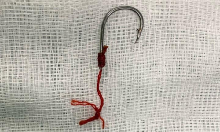 Bỗng nhiên đau ở vùng hậu môn, đi khám thì phát hiện dị vật lạ 