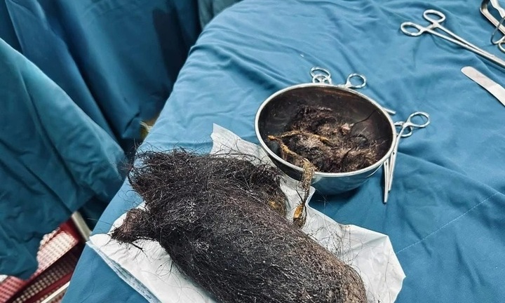 Phẫu thuật lấy búi tóc khổng lồ nặng gần 1kg trong dạ dày của bé gái 12 tuổi