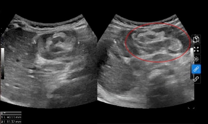 Cứu bé trai 8 tháng tuổi hôn mê sâu vì bị lồng ruột