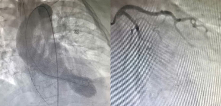 Người phụ nữ mắc hội chứng “trái tim tan vỡ” sau khi ngã thang