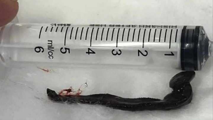 Đi bắt cá ở suối, người phụ nữ bị “sinh vật lạ” chui vào mũi, đến viện mới biết con gì