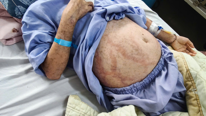 Tự ý dùng thuốc cảm khi bị sốt, cô gái trẻ nhập viện trong tình trạng dị ứng nặng