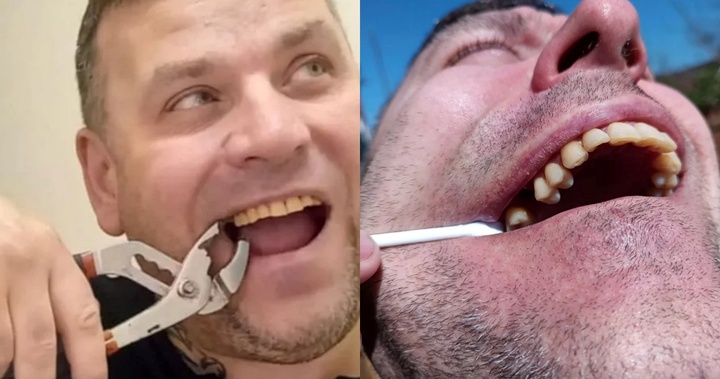 Tự nhổ răng tại nhà bằng cờ lê, người đàn ông nhận cái kết đau đớn