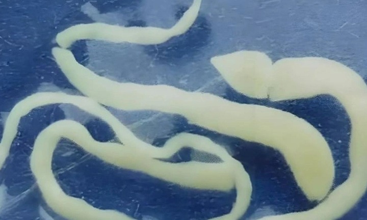 Thói quen nguy hiểm khiến giun làm tổ trong não cô gái suốt 2 năm