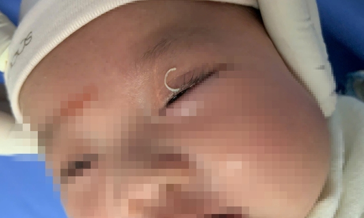 Mẹ cắt móng tay văng vào mắt, bé 2 tháng tuổi ở Ninh Bình phải nhập viện cấp cứu