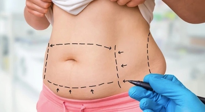 Bi hài hậu vận sau thẩm mỹ: Tưởng làm đẹp ai ngờ rước họa, rốn sưng phù, mưng mủ vì...7 đầu tăm bông