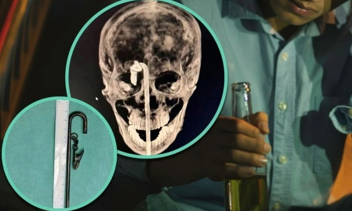 Say rượu ngã vào bàn ăn, thanh niên bị thanh kim loại đâm trúng mặt