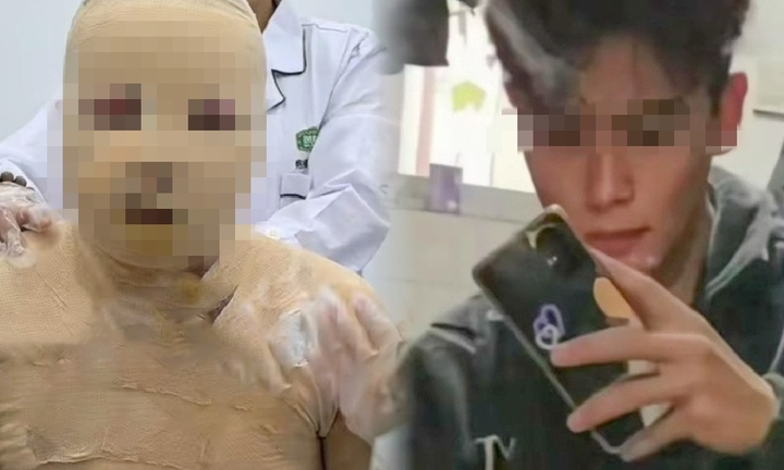 Nam sinh bỏng 90% cơ thể vì bị bạn cùng phòng nhốt trong đám cháy