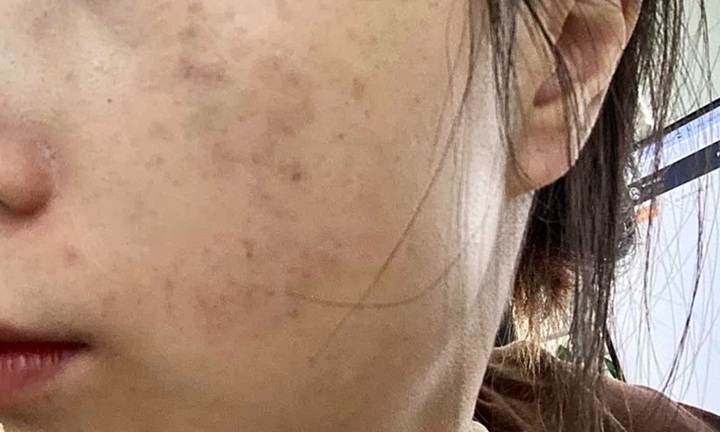 Bi hài hậu vận sau thẩm mỹ: Tiêm filler dởm, cô gái trẻ 