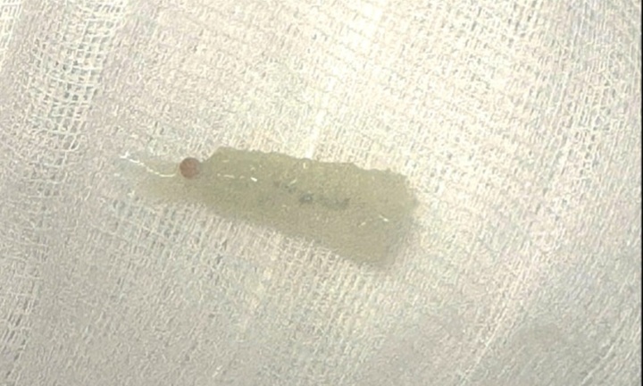 Cụ bà suy hô hấp vì đầu chổi vệ sinh nòng khí quản rơi vào đường thở