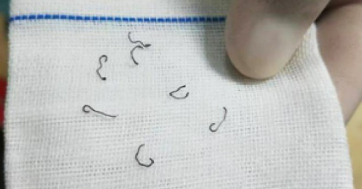 Người phụ nữ 8 lần nhập viện vì đinh 