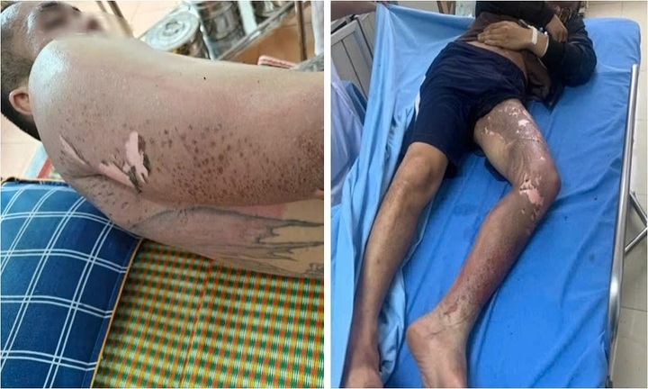 Bắc Kạn: Leo trạm biến áp trộm dây điện, 2 đối tượng bỏng nặng