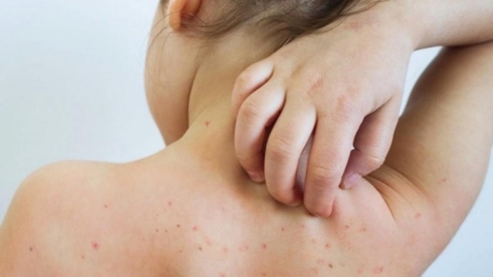 Một ca rubella vừa phát hiện: Bố mẹ chủ quan, trẻ lãnh hậu quả