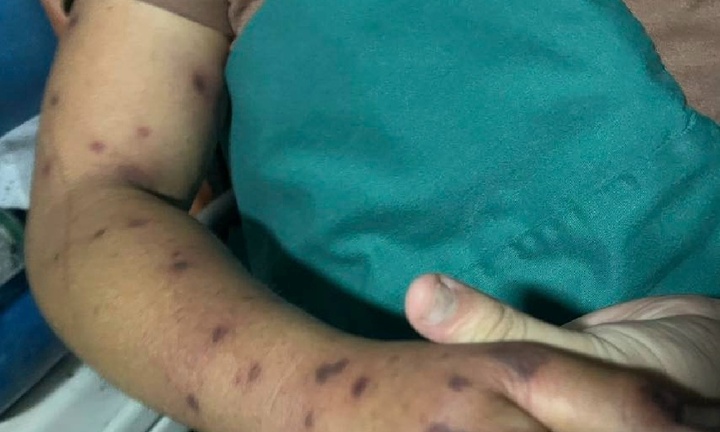 Bị ong bắp cày đốt hàng trăm nốt, người đàn ông 44 tuổi nguy kịch