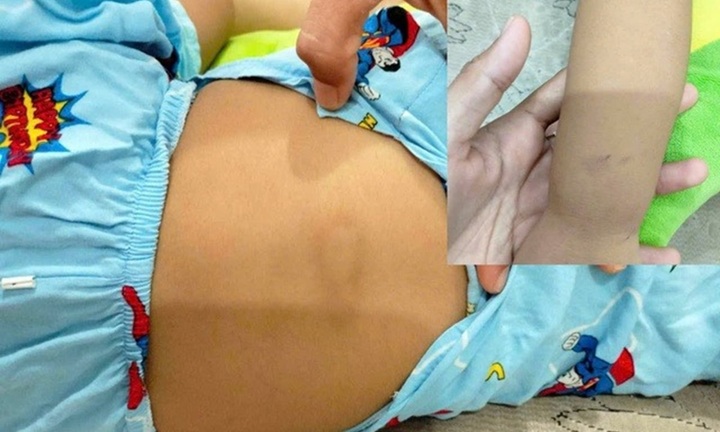 Nghi vấn bé gái gần 3 tuổi bị bạo hành tại điểm giữ trẻ ở Bình Thuận, bác sĩ chẩn đoán gì?