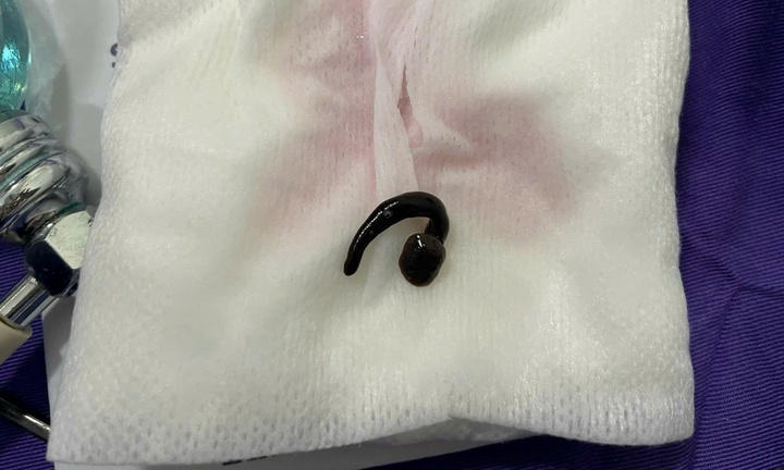  Tắm suối cùng anh trai, bé 3 tuổi nhập viện vì đỉa chui vào đường thở