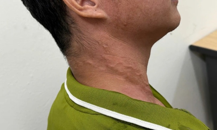 Ghi nhận bệnh nhân mắc giun rồng tại Việt Nam, bác sĩ chỉ cách phát hiện