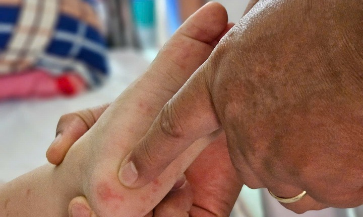 Bệnh tay chân miệng có xu hướng gia tăng