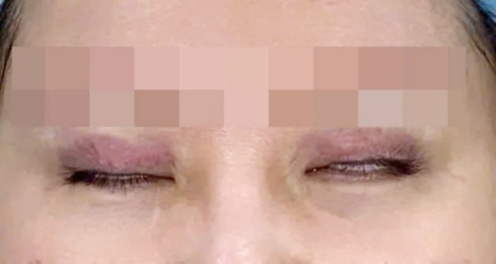 Nữ sinh 22 tuổi “khóc ròng” sau thẩm mỹ trào lưu 