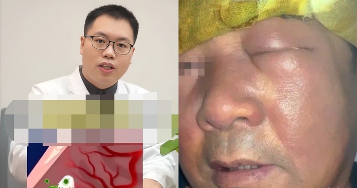 Người đàn ông mặt sưng phù, nhiễm trùng nặng do thói quen nhiều người mắc phải