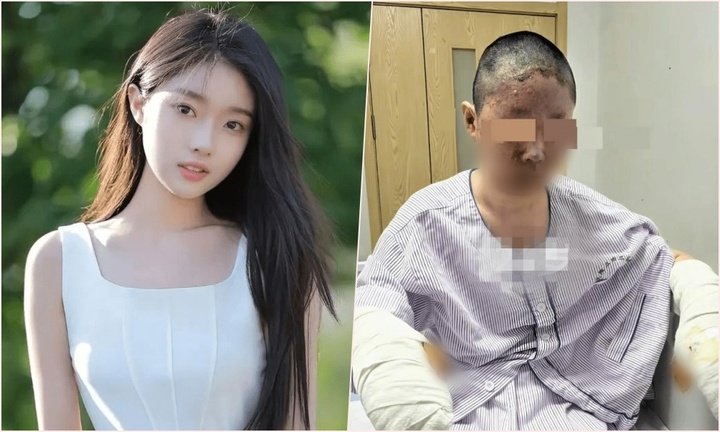 Xót xa nữ người mẫu xinh đẹp bị bỏng nặng, mặt biến dạng nghiêm trọng sau vụ nổ khí gas