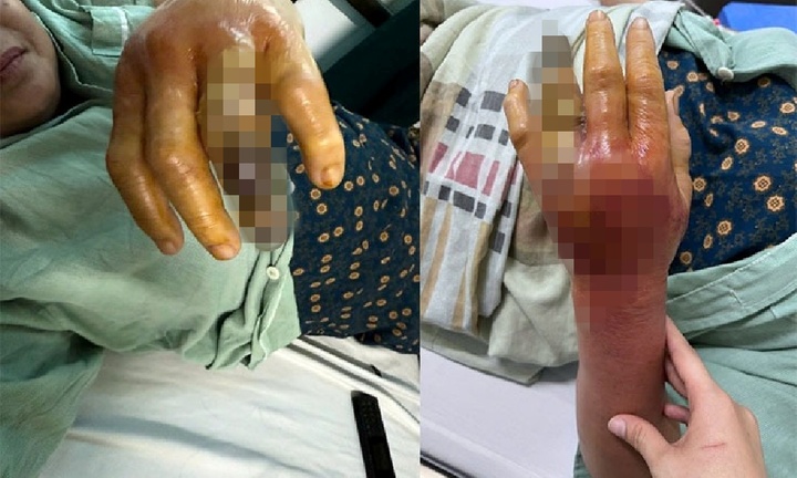 Người phụ nữ bị hoại tử bàn tay sau khi bị gai cá đâm