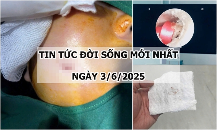 Tin tức đời sống 3/6: Cô gái gặp biến chứng sau phẫu thuật tạo má lúm đồng tiền