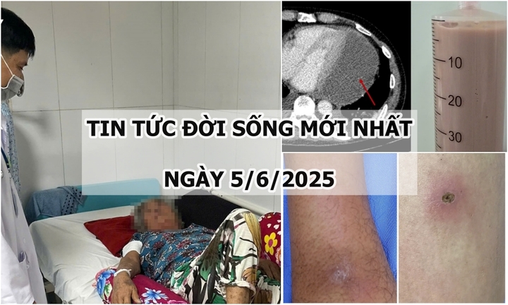 Tin tức đời sống 5/6: Nguyên nhân khiến tim bệnh nhân 55 tuổi bị ép chặt, đe dọa tính mạng từng giây