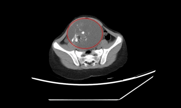 Hi hữu: Bé 6 tuổi mắc u quái buồng trứng kích thước