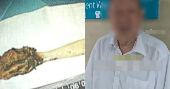 Chiếc bàn chải tồn tại bên trong cơ thể người đàn ông hơn nửa thế kỷ