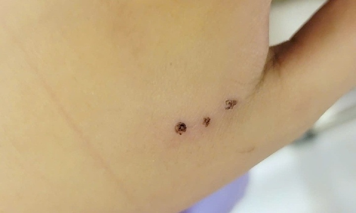 Chuột cắn gây sưng đau nghiêm trọng, bệnh nhi 10 tuổi phải nhập viện