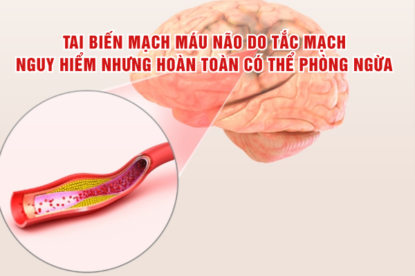 Tai biến mạch máu não do tắc mạch: Nguy hiểm nhưng hoàn toàn có thể phòng ngừa