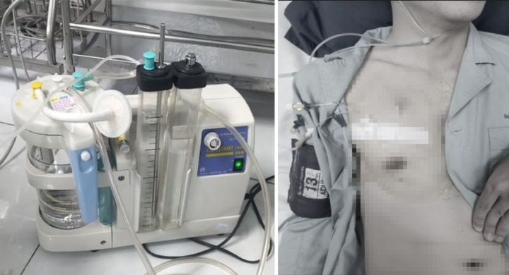 Tập đẩy tạ quá mức, nam thanh niên 25 tuổi tràn khí màng phổi nguy hiểm