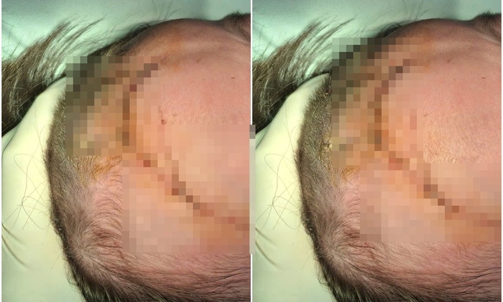 Qua nhà cậu chơi, bé trai 24 tháng tuổi bị chó cỏ cắn, vết thương nghiêm trọng vùng đầu