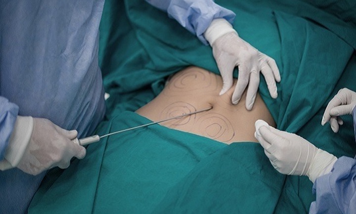 Bi hài hậu vận thẩm mỹ: Hút mỡ, cắt sẹo tại spa