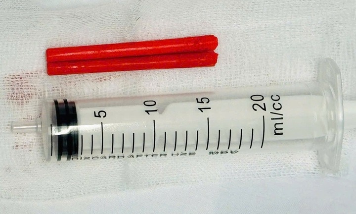 Người đàn ông ở TP.HCM sống chung với 2 chiếc đũa trong mũi suốt một năm mà không biết