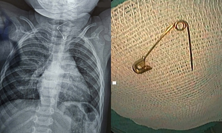 Bé 12 tháng tuổi nhập viện khẩn cấp vì nuốt kim băng
