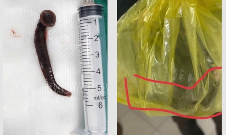 Làm việc trên cánh đồng, người đàn ông bị đỉa chui vào nơi 