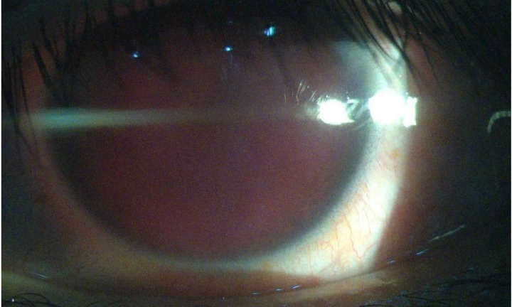 Cấp cứu nam thanh niên bị mảnh vỡ bóng đèn huỳnh quang găm vào mắt