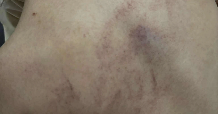 Vụ bé gái mẫu giáo bị đánh tím lưng tại Hà Nội: Giáo viên thừa nhận hành vi bạo hành