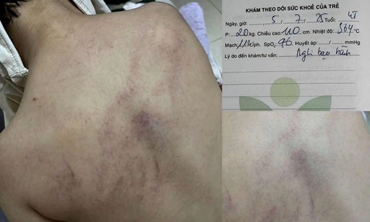 Vụ bé gái 4 tuổi bị giáo viên đánh đập, ném vào tường ở Hà Nội: Đang chờ kết luận giám định thương tích